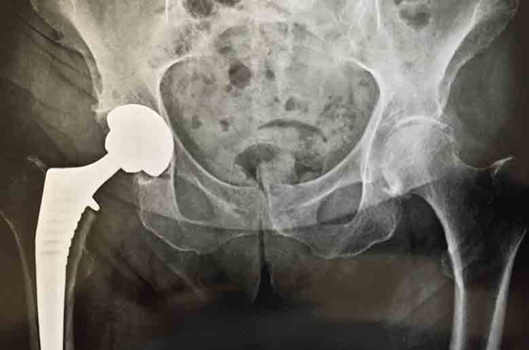 ProthesetotaledelaHanche clinique avicenne