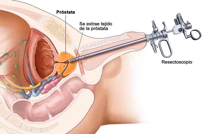 récupération après ablation prostate)